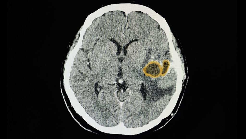 Alerta en EE.UU. por el aumento infección cerebral en niños